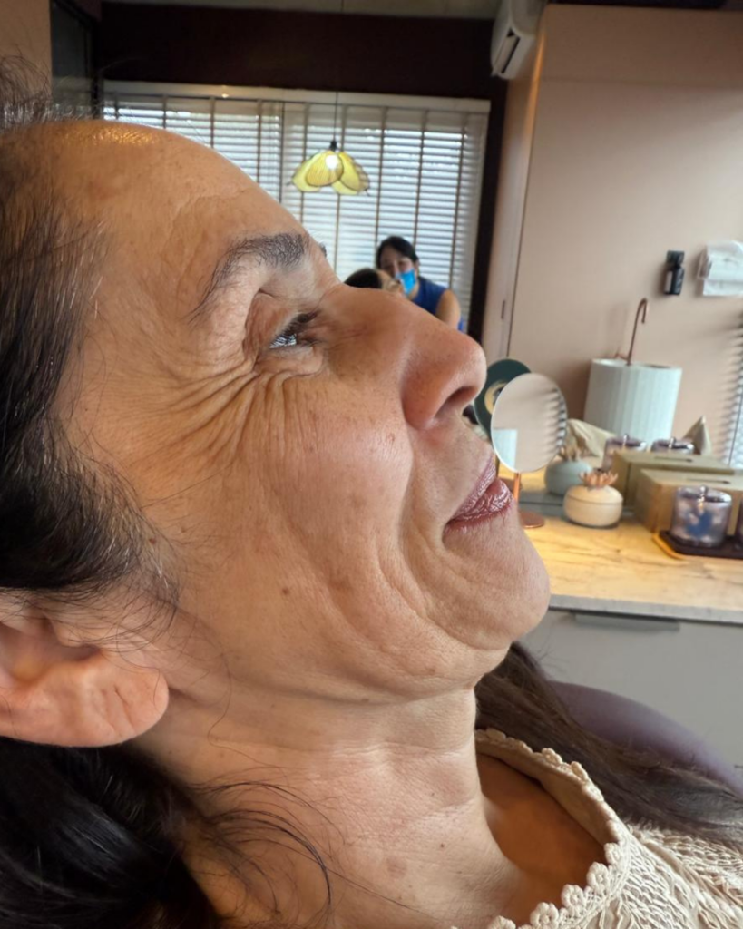 Paciente na faixa dos 40+ em avaliação de harmonização facial em Atibaia