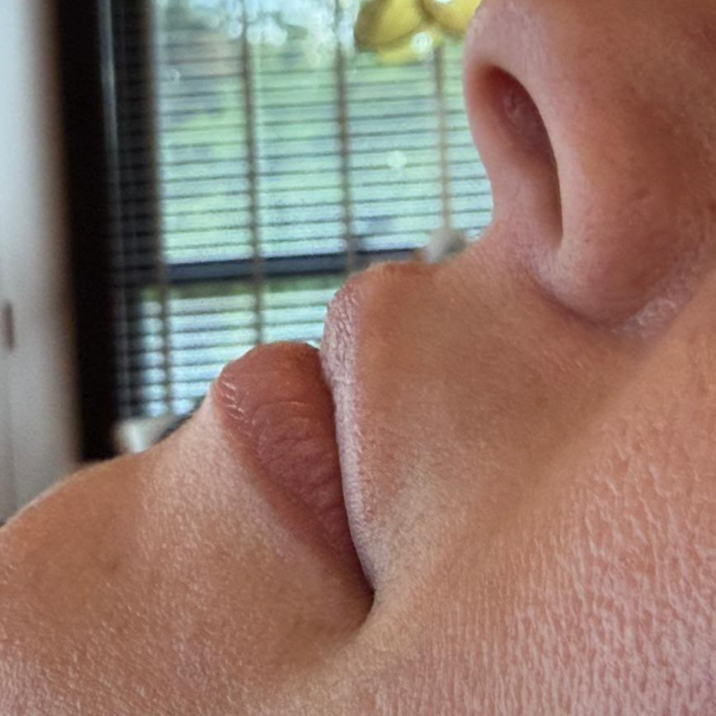 Pele hidratada e com viço após skinbooster em Atibaia