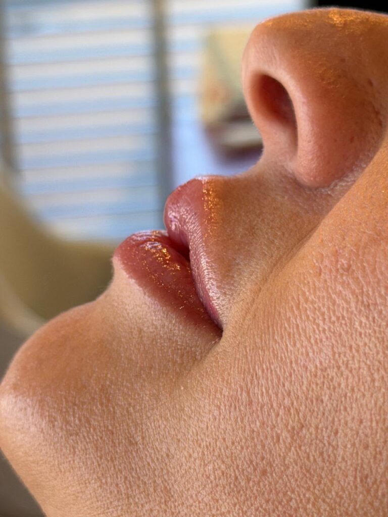 Lábios com preenchimento labial natural feito pela Dra. Telma Lots em Atibaia